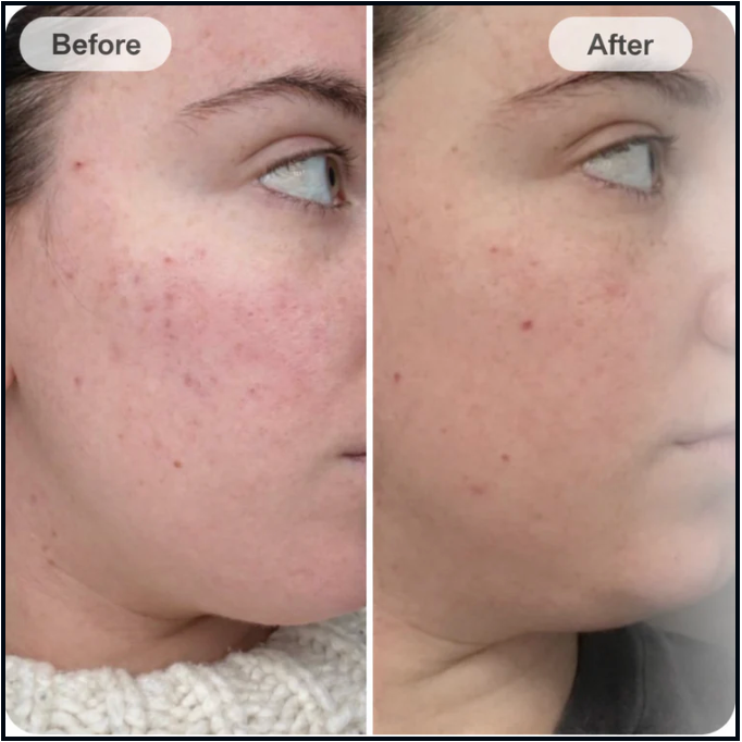 Customer skin before and after a consistent LED face mask routine