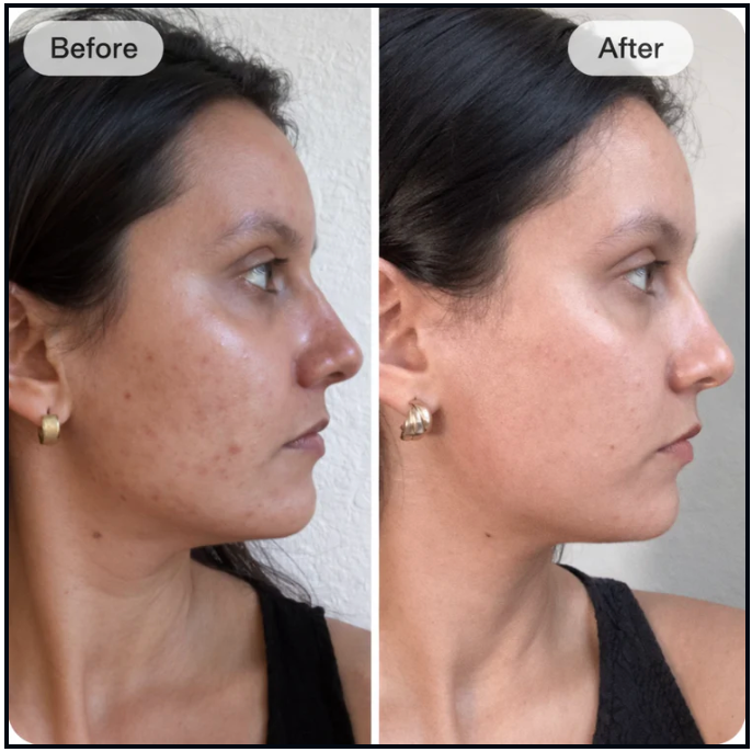 Customer profile before and after a consistent LED face mask routine
