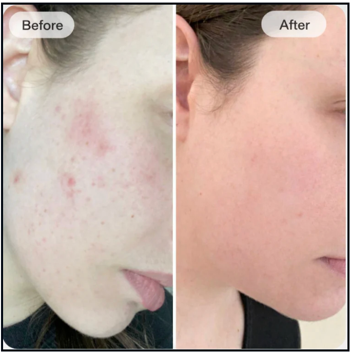 Customer cheek before and after a consistent LED face mask routine