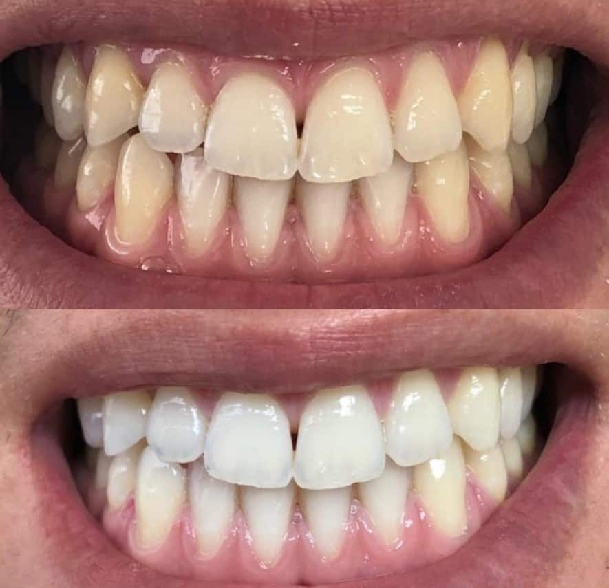 Before and after teeth whitening result 1
