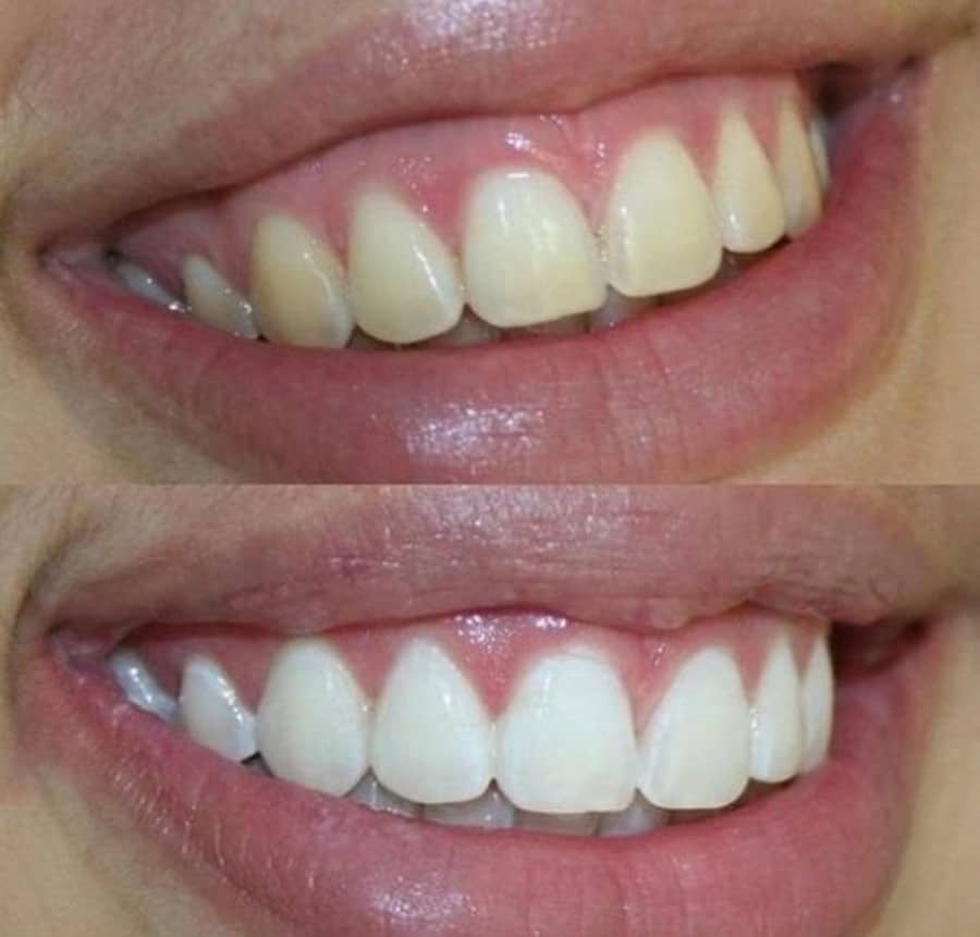 Before and after teeth whitening result 2