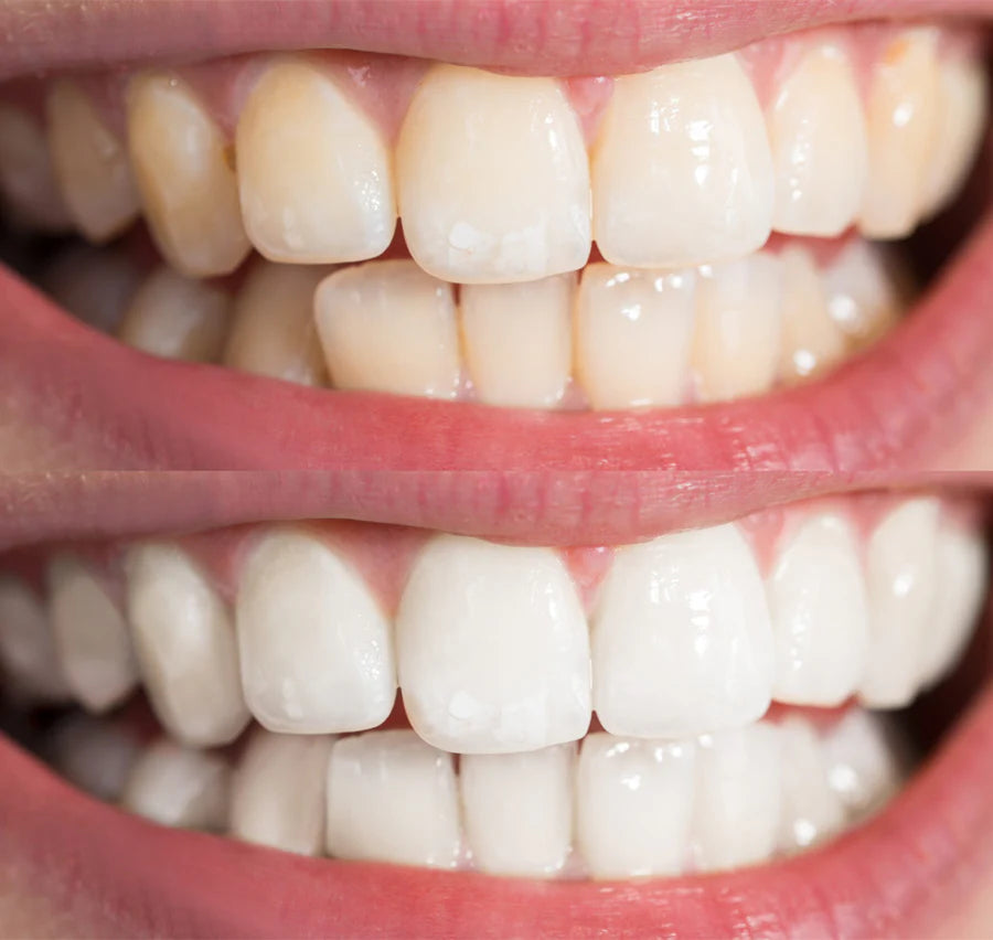 Before and after teeth whitening result 3