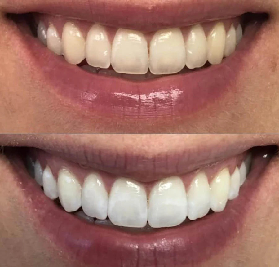 Before and after teeth whitening result 4