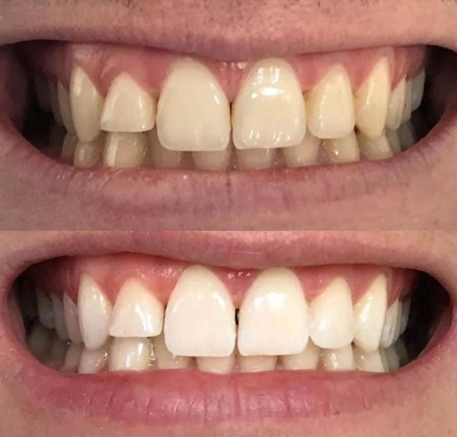 Before and after teeth whitening result 5