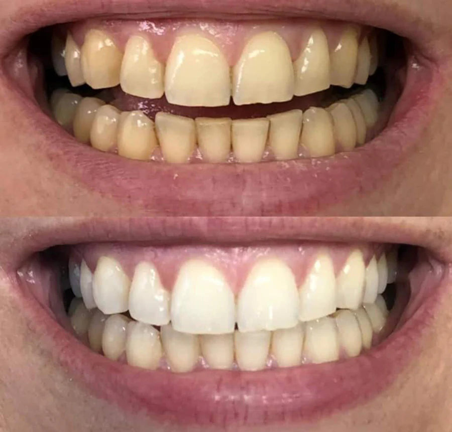 Before and after teeth whitening result 6